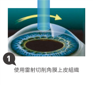 使用雷射切削角膜上皮組織