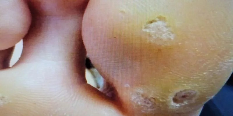 陳男腳拇指出現菜花病毒。圖/洪啟庭提供